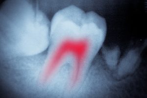 Columbia root canal